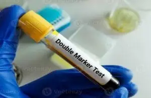 double marker test in pregnancy